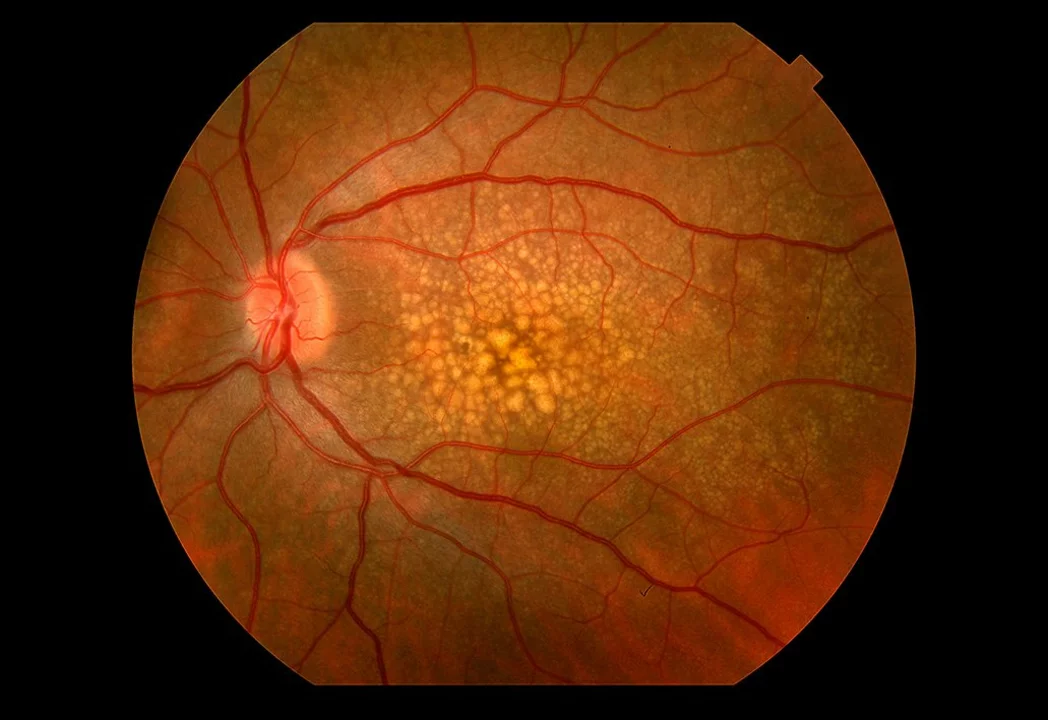 The Connection Between Myosis and Macular Degeneration