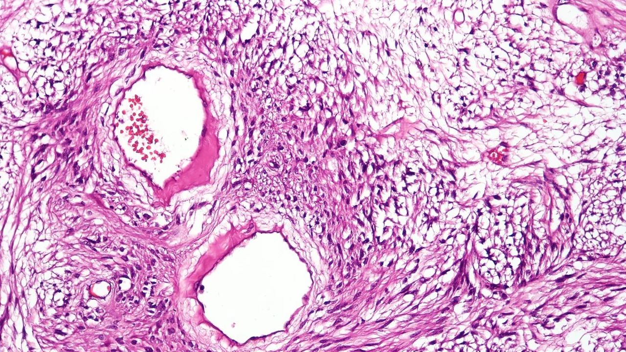 The role of sorafenib in the treatment of gastrointestinal stromal tumors