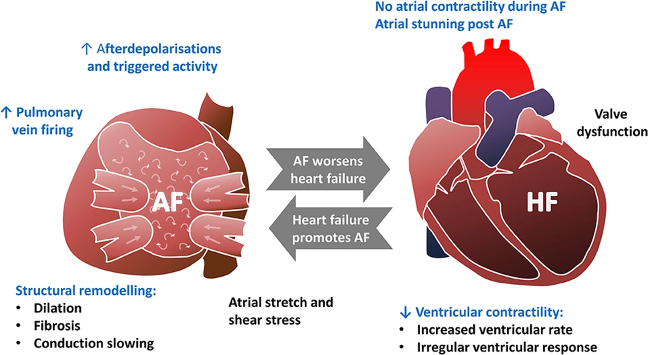 The Connection between Irregular Heartbeat and Heart Failure